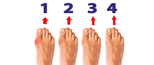 Chứng vẹo ngón chân cái (Bunion) là gì?